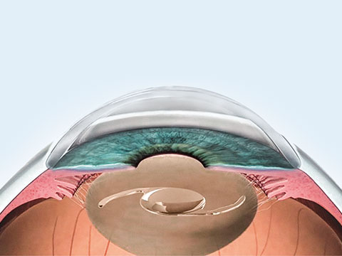 What Is Intraocular Lens IOL